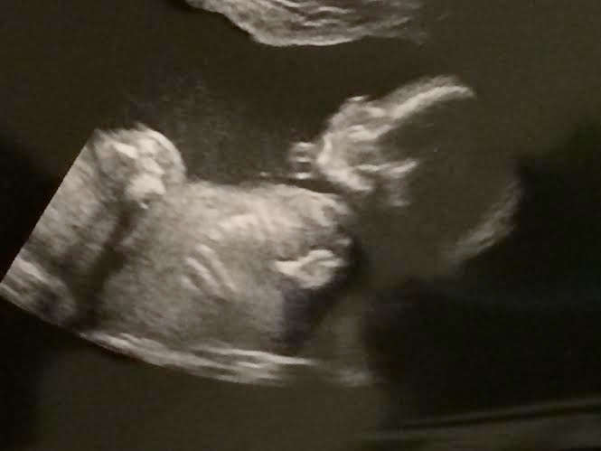 20 week scan