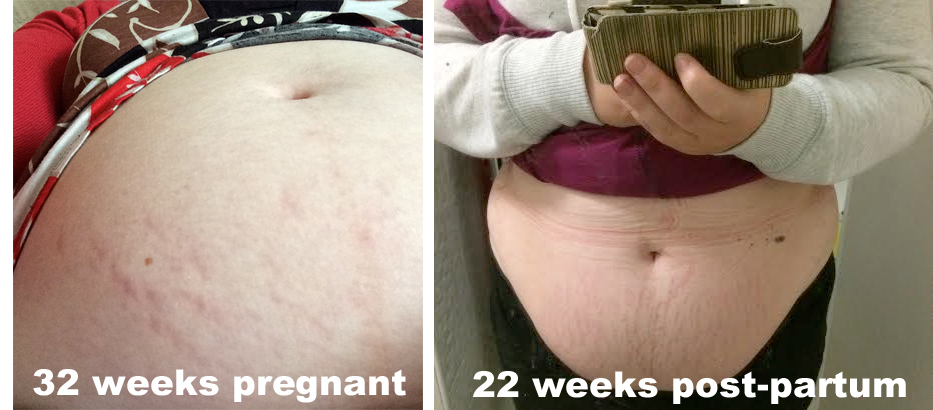 stretch marks before and after