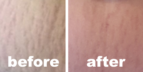 before and after remescar stretch marks